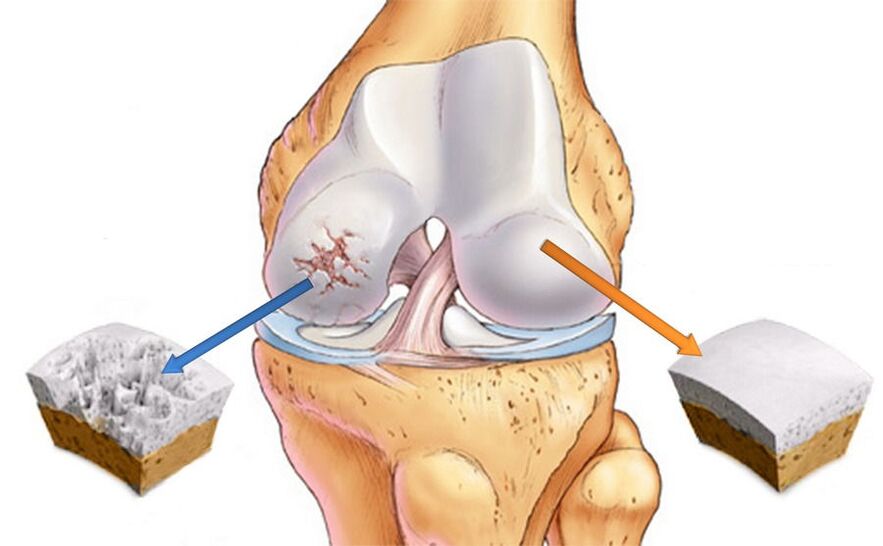 Artrosis de la articulación de la rodilla y cartílago sano. 