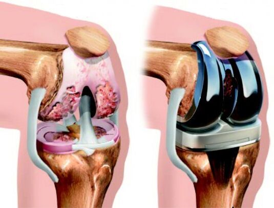 Resultado de la cirugía de reemplazo de rodilla por artrosis