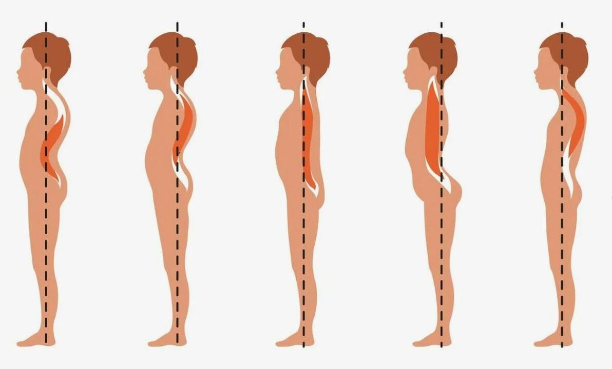 grado de desarrollo de la osteocondrosis lumbar