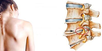 El mecanismo de desarrollo de la osteocondrosis cervical