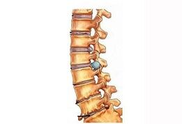 Etapas de desarrollo de la osteocondrosis cervical