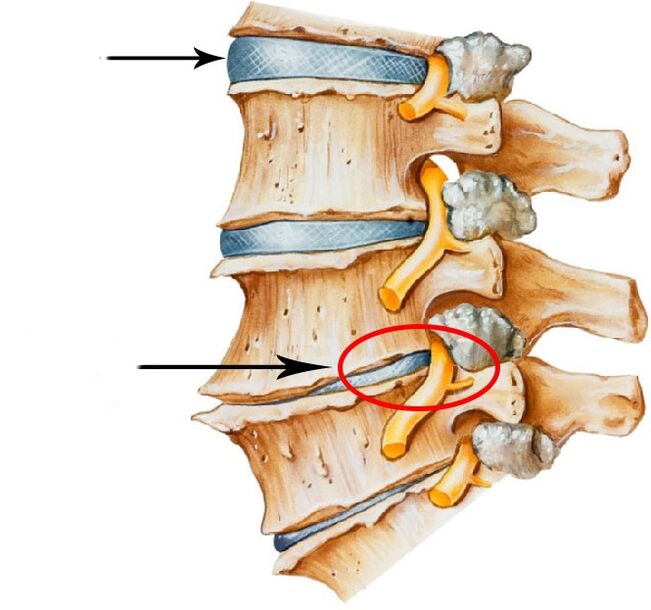 Desarrollo de hernia de disco