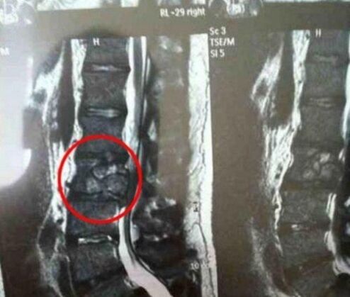 El tumor de la columna en la imagen