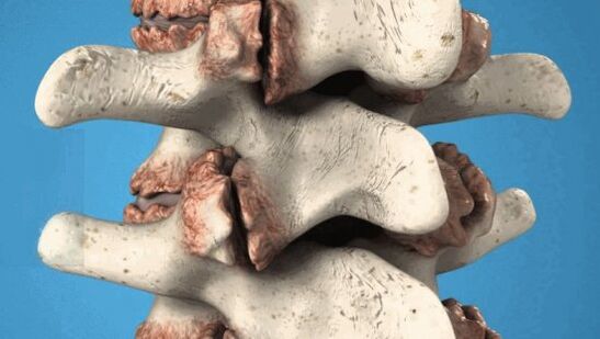 Osteofitos de las vértebras crecimientos patológicos que dañan los nervios y los vasos sanguíneos