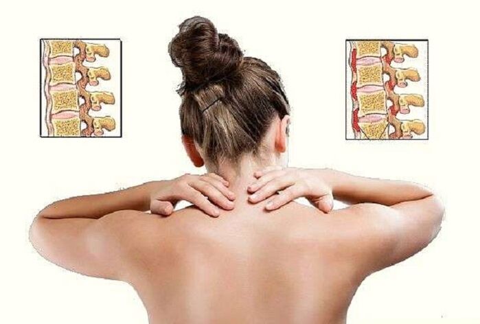 osteocondrosis cervical como causa de dolor debajo del omóplato izquierdo