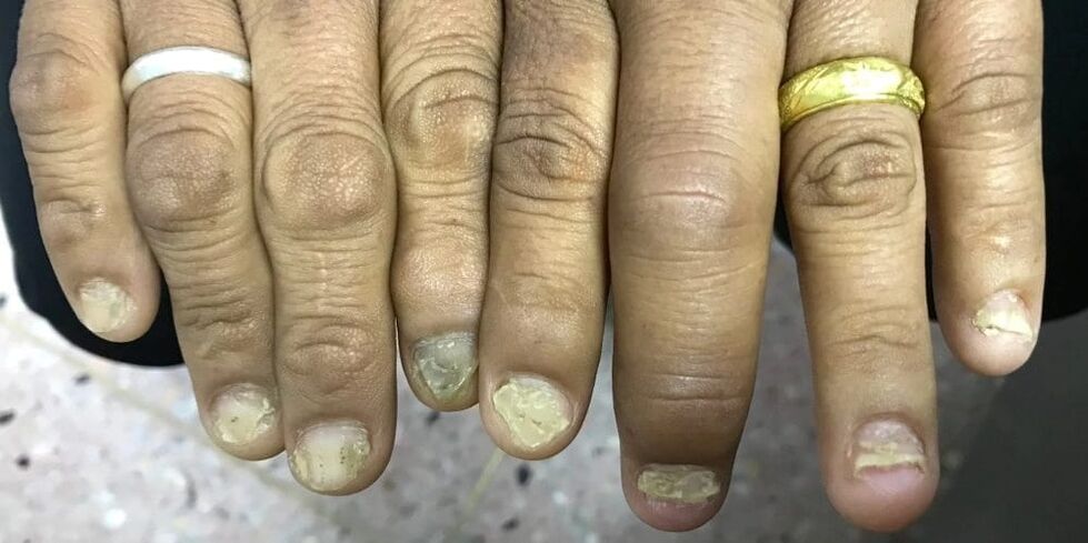 La hinchazón de los dedos y la deformación de la placa ungueal pueden indicar el desarrollo de artritis psoriásica.