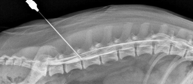 bloqueo de la columna con osteocondrosis