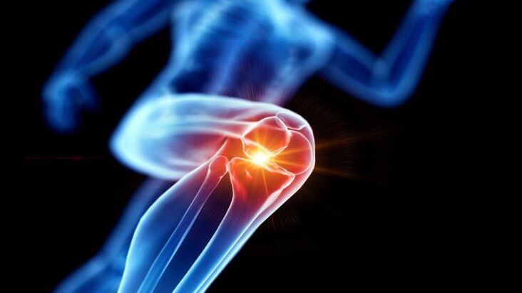 osteoartritis de la articulación de la rodilla